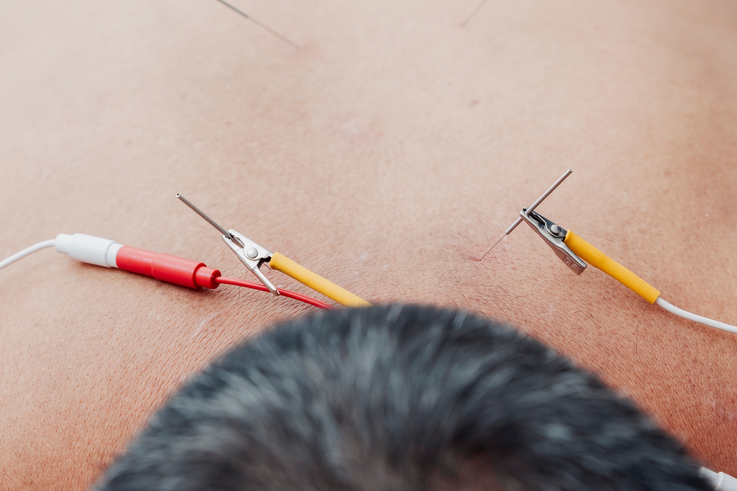 Electroacupuncture needles with clip leads on a man's upper back