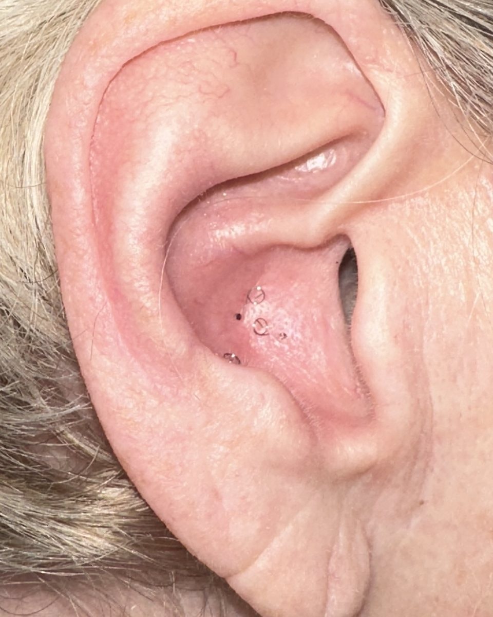 SAAT implants in the allergy zone of the ear after treatment with Dr. Gordon